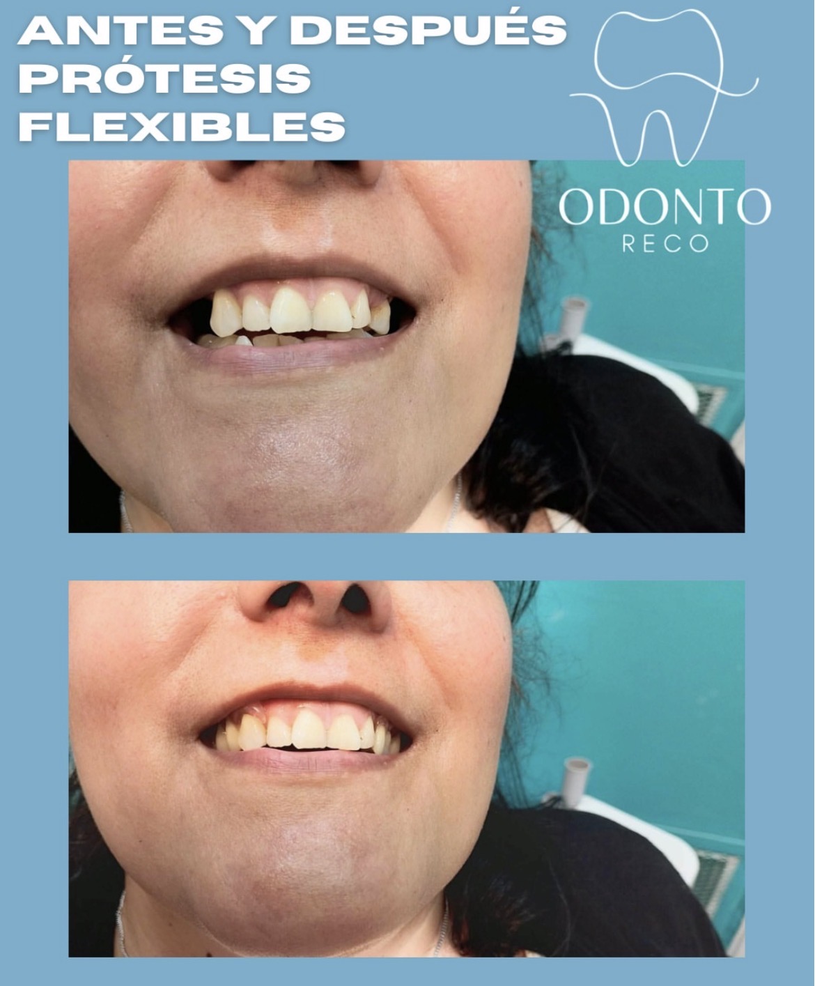 Antes y después tratamiento dental 3